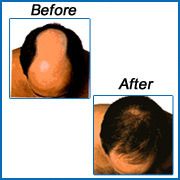 HAIR-PRO Advanced Hair Transplant Center